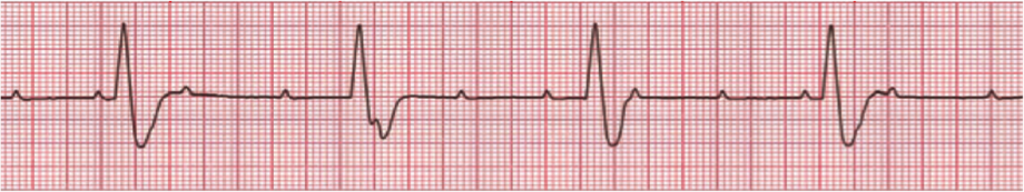 ECG 8.1 Bloqueos auriculoventriculares - Cardio Science