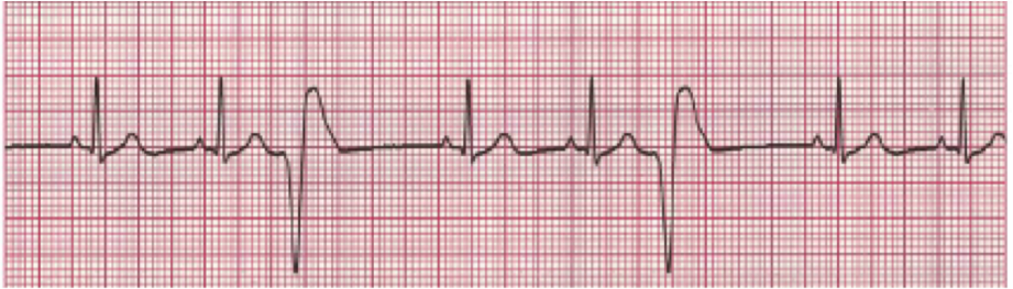 bigeminismo ventricular