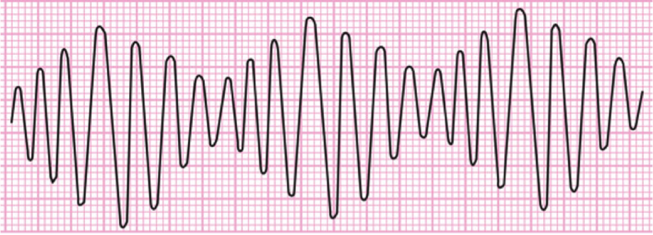 Ecg 7 8 Arritmias Ventriculares Cardio Science