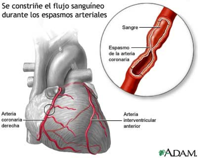 des-2-2-caso-cl-nico-sismo-y-coraz-n-angina-de-prinzmetal-cardio